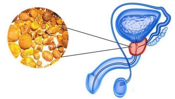 Calculé dans la glande de la prostate
