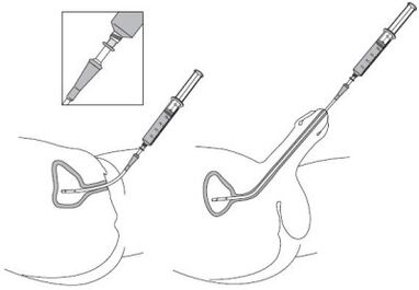 Intégration d'une solution médicamenteuse dans l'urètre