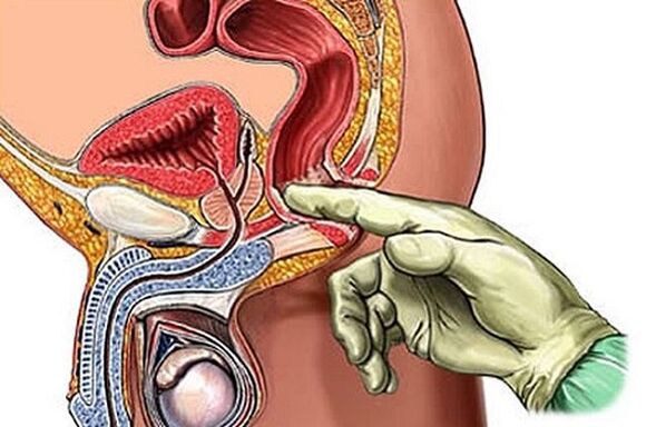Massage de la prostate pour traiter la prostatite