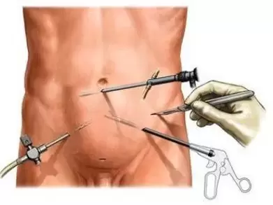 traitement chirurgical de la prostatite chronique