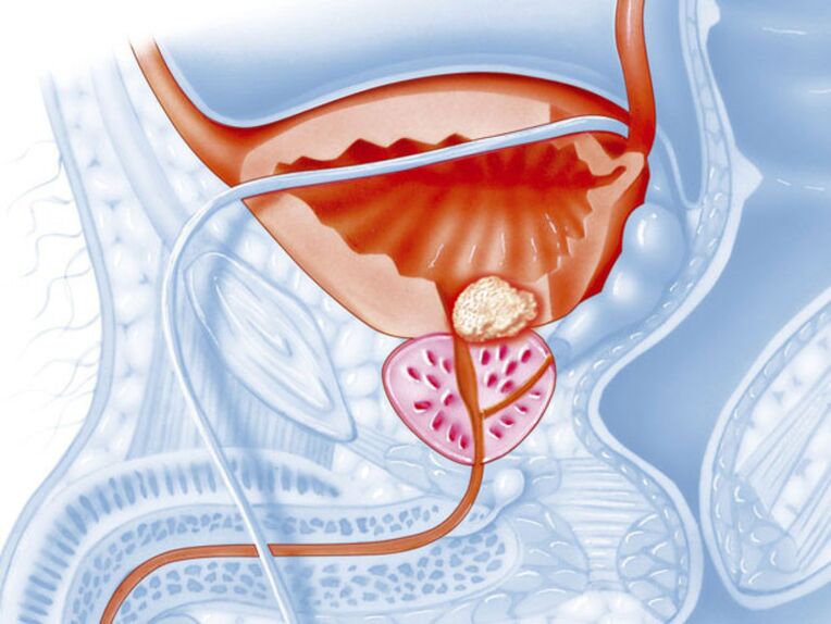 Avec la prostatite chronique, la lumière de l'urètre se rétrécit, ce qui rend difficile le drainage de l'urine. 