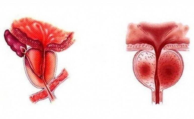 Inflammation aiguë de la prostate pouvant devenir chronique